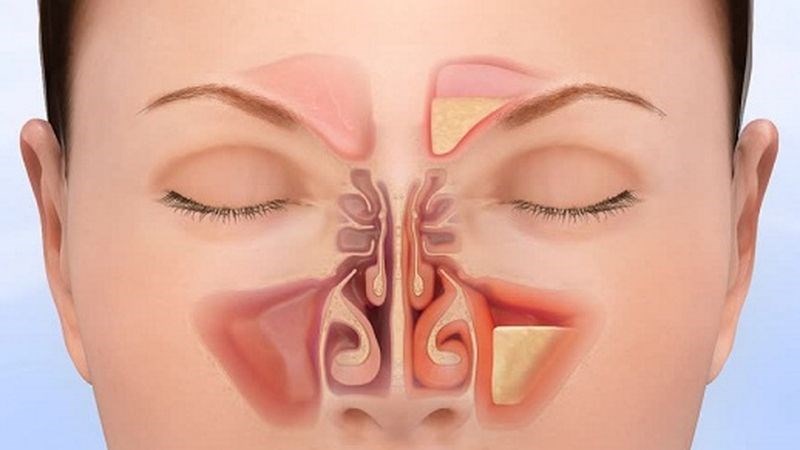 Nguyên nhân gây nghẹt mũi