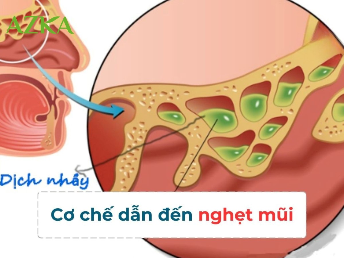 Dịch nhầy ứ đọng gây tắc nghẽn dẫn đến nghẹt mũi khi ngủ