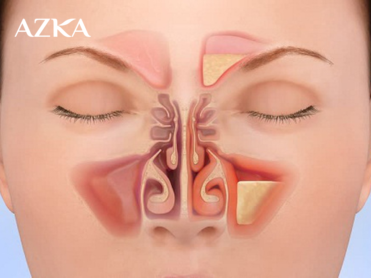 Viêm xoang có thể do virus, vi khuẩn gây ra