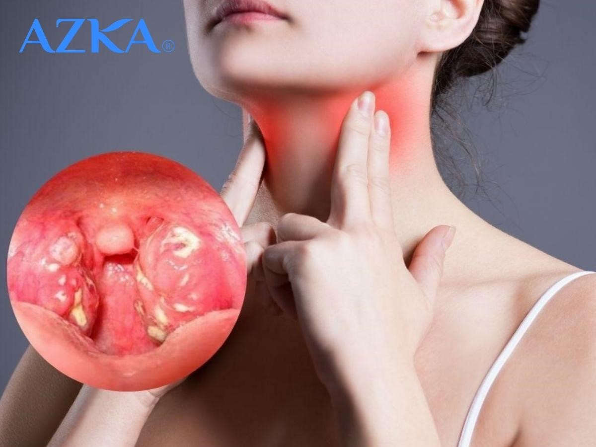 Viêm họng do virus gây ra