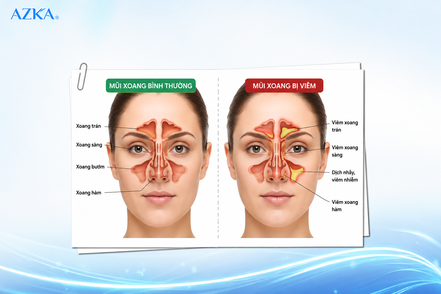 Hình ảnh mũi xoang bình thường và mũi xoang bị viêm